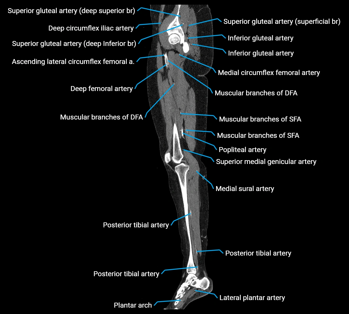 CTA lower limb sagittal cross sectional anatomy labelled image _37 (3).webp